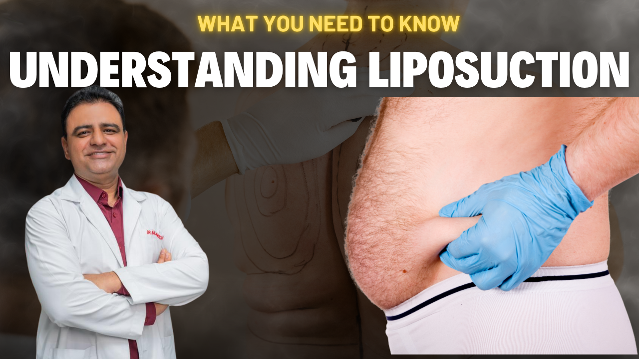 Understanding Liposuction: What You Need to Know